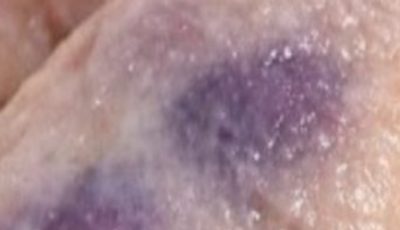 Purple Blotches on Thawed Chicken Breasts: Is It Safe to Cook or Should You Throw It Away?