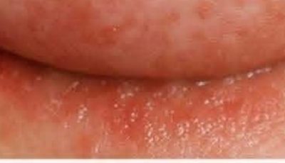 What to Do Today if You Have an Itchy Rash Under Your Breasts in Winter