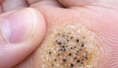 My daughter is limping from this hard rough spot with black dots on her sole. She has a dance recital tomorrow and is crying in pain. Need a fast fix