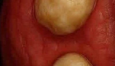 What are those ‘white stones’ that appear in the mouth and cause bad breath?