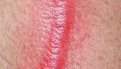 My husband woke up with this hard red line running down his leg. It feels warm to the touch and he’s in pain. ER wait time is 8 hours. Is this serious?