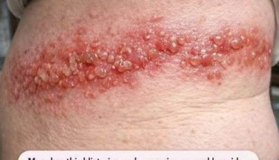 My mom has a blistering rash around her side. She says the burning pain is unbearable. The wait in the ER is 8 hours! What can we do?