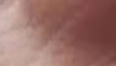 BE CAREFUL, if you get these bruises on your body, it means you have Ca…see more